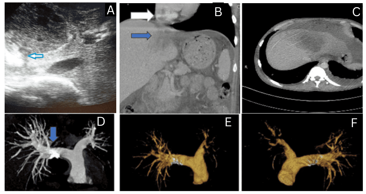Absceso hepático amébico rompe la vena cava inferior y causa embolia pulmonar masiva en paciente
