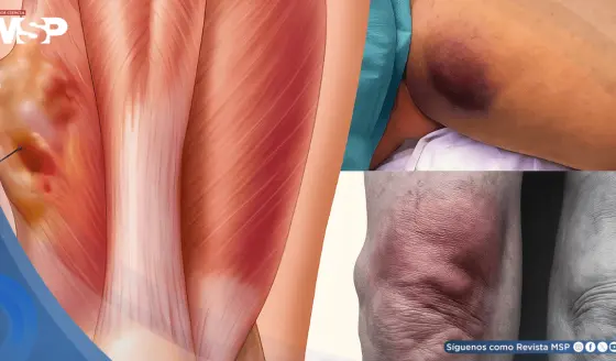 Sarcomas: el cáncer que con frecuencia se confunde con un golpe o una lesión común y avanza en silencio