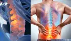 Terapia cognitiva funcional podría reducir la discapacidad por dolor lumbar crónico hasta por tres años