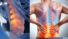 Terapia cognitiva funcional podría reducir la discapacidad por dolor lumbar crónico hasta por tres años