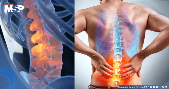 Terapia cognitiva funcional podría reducir la discapacidad por dolor lumbar crónico hasta por tres años
