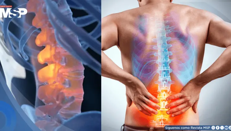 Terapia cognitiva funcional podría reducir la discapacidad por dolor lumbar crónico hasta por tres años