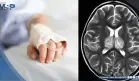 Alertan sobre aumento de encefalopatía necrosante infantil asociada a la gripe