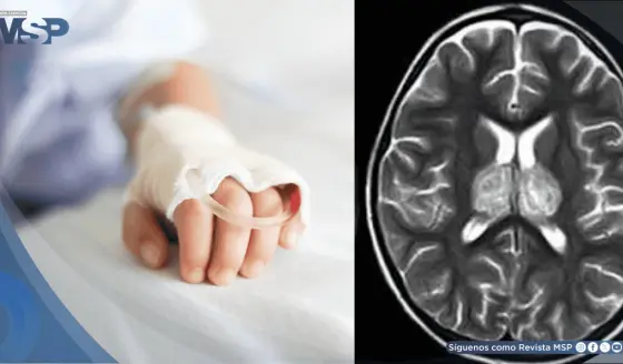 Alertan sobre aumento de encefalopatía necrosante infantil asociada a la gripe