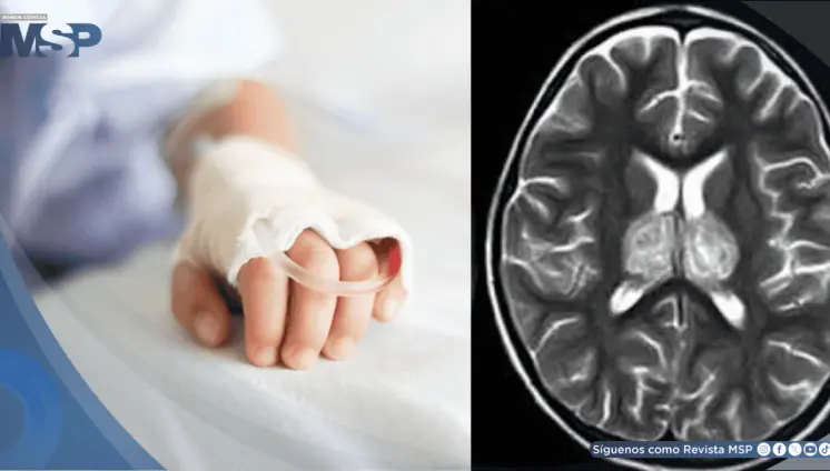 Alertan sobre aumento de encefalopatía necrosante infantil asociada a la gripe Alertan sobre aumento de encefalopatía necrosante infantil asociada a la gripe