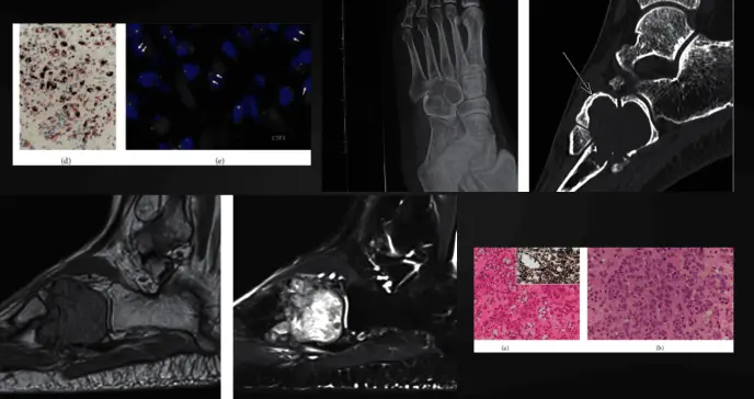 Tumor tenosinovial de células gigantes en huesos simuló histiocitosis en paciente con dolor e inflamación
