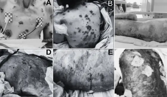 Pénfigo vulgar refractario a corticoides tratado con éxito con rituximab sin dermatología hospitalaria