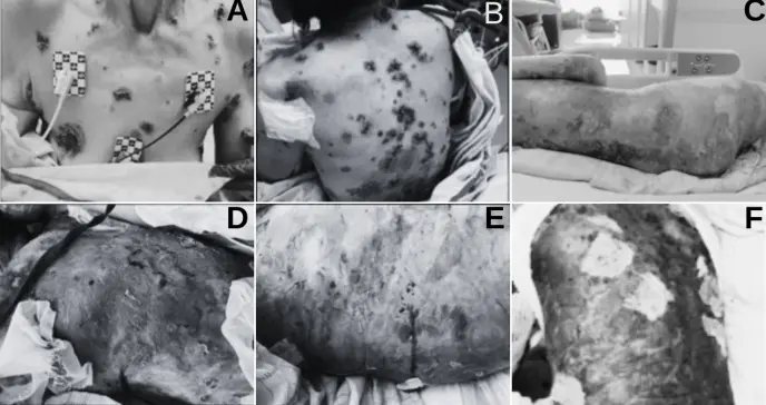 Pénfigo vulgar refractario a corticoides tratado con éxito con rituximab sin dermatología hospitalaria