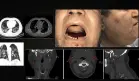 Detectan hematoma sublingual en paciente diabético con COVID-19 bajo anticoagulación