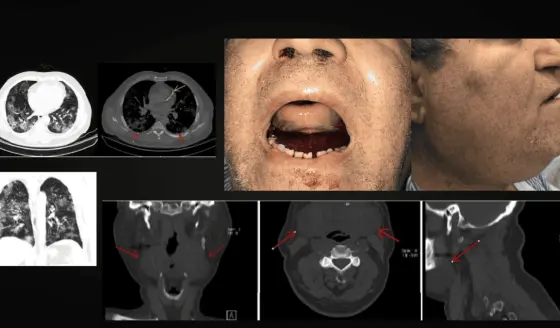 Detectan hematoma sublingual en paciente diabético con COVID-19 bajo anticoagulación