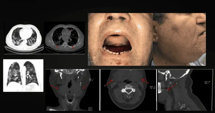 Detectan hematoma sublingual en paciente diabético con COVID-19 bajo anticoagulación