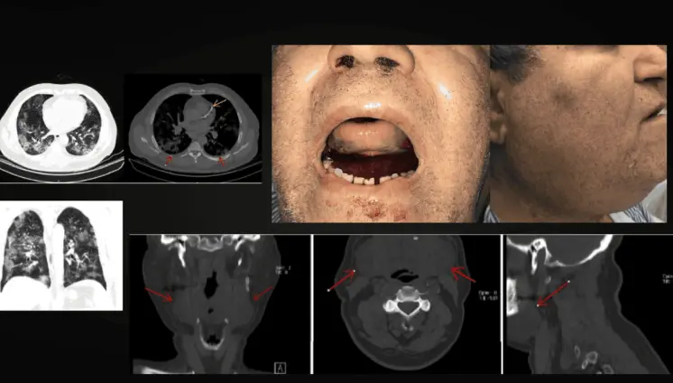Detectan hematoma sublingual en paciente diabético con COVID-19 bajo anticoagulación
