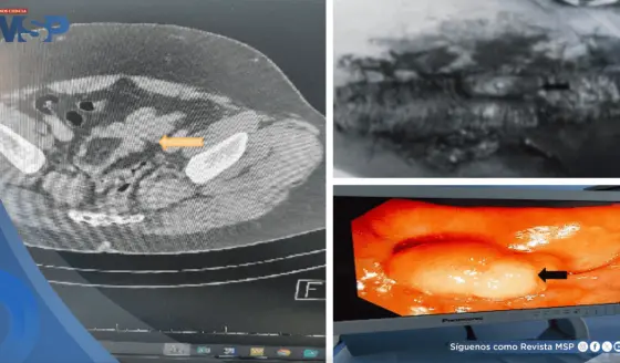Dolor abdominal persistente terminó revelando un lipoma gigante en el colon sigmoide