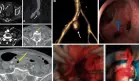 Detectan aneurisma micótico con fístula entre la arteria ilíaca y el colon en paciente con hematoquecia 