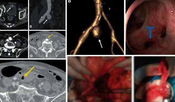 Detectan aneurisma micótico con fístula entre la arteria ilíaca y el colon en paciente con hematoquecia 