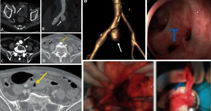 Detectan aneurisma micótico con fístula entre la arteria ilíaca y el colon en paciente con hematoquecia 