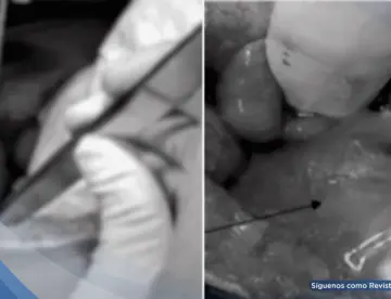 Apendicitis complicada con absceso y ruptura de quiste ovárico en mujer con taquicardia y anorexia 