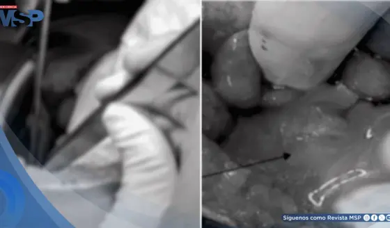 Apendicitis complicada con absceso y ruptura de quiste ovárico en mujer con taquicardia y anorexia 