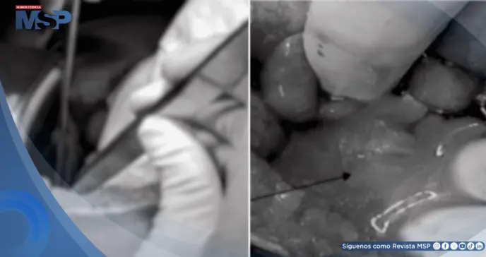 Apendicitis complicada con absceso y ruptura de quiste ovárico en mujer con taquicardia y anorexia 