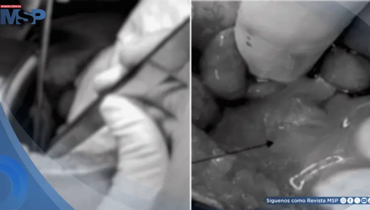 Apendicitis complicada con absceso y ruptura de quiste ovárico en mujer con taquicardia y anorexia 