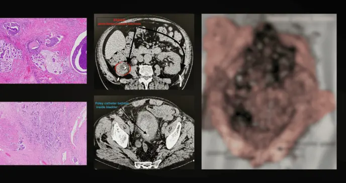 Paciente de 89 años desarrolla peritonitis química por filtración urinaria secundaria a cáncer vesical