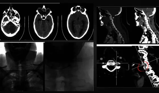 Joven con hematemesis sufre derrame cerebral isquémico tras herida de arma blanca en el cuello