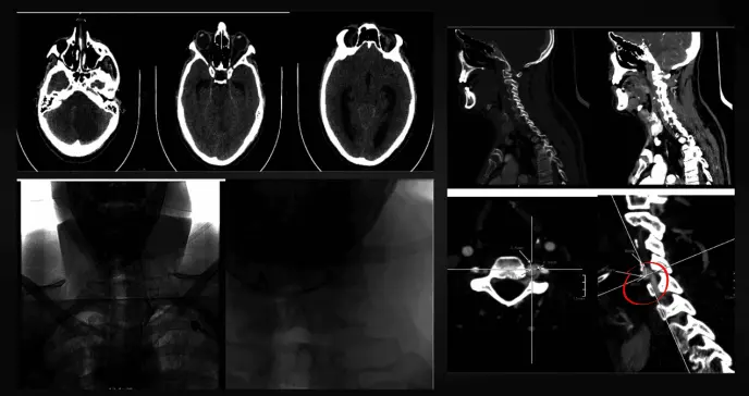 Joven con hematemesis sufre derrame cerebral isquémico tras herida de arma blanca en el cuello