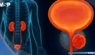 Alternativa a la cirugía en cáncer de vejiga: TAR-200 libera quimioterapia sostenida con 82% de respuesta