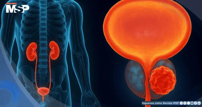 Alternativa a la cirugía en cáncer de vejiga: TAR-200 libera quimioterapia sostenida con 82% de respuesta