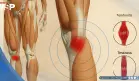 Tendinitis vs. tendinosis: diferencias, síntomas y tratamiento efectivo