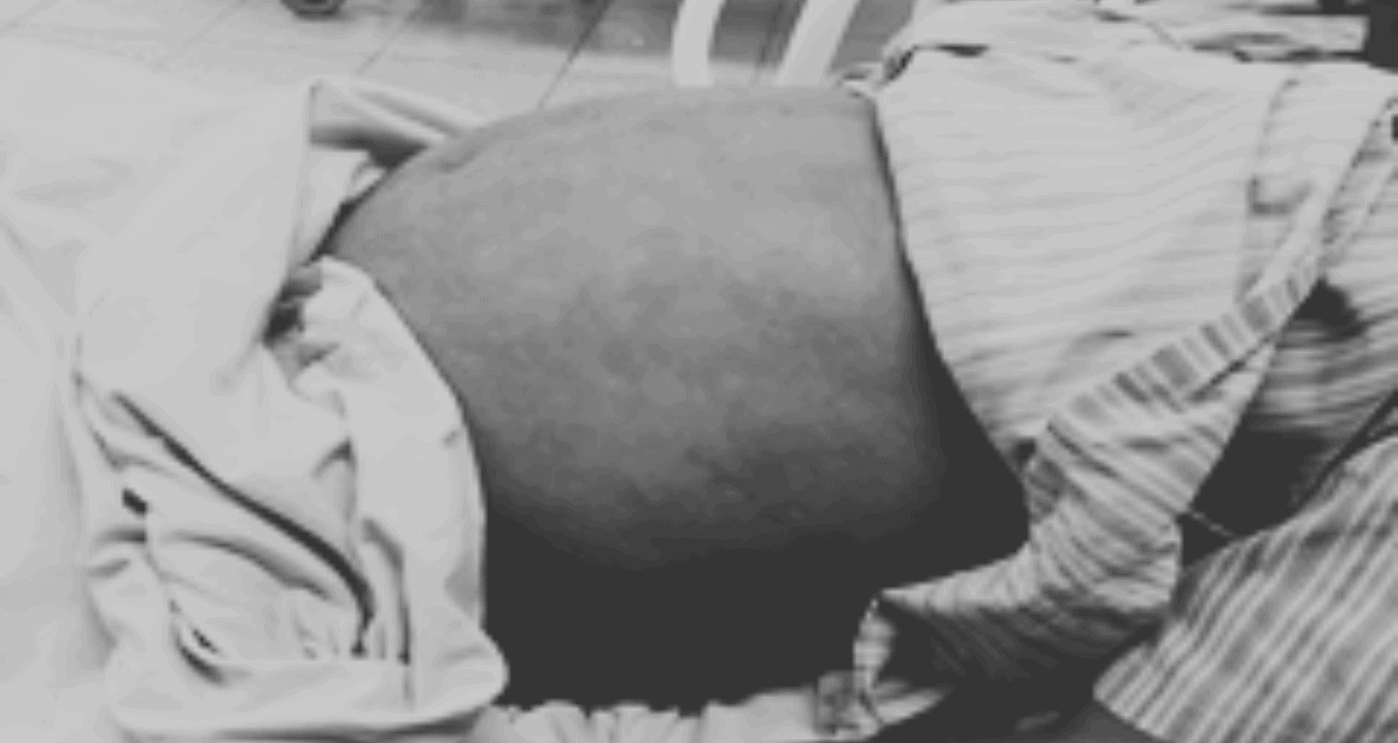 Pancreatitis aguda grave en un paciente fumador