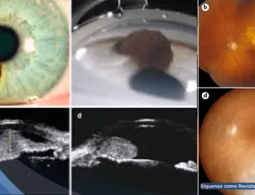 ¿Te cuidas la vista? El melanoma uveal puede no dar señales antes de producir metástasis hepáticas