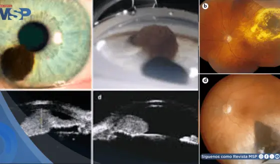 ¿Te cuidas la vista? El melanoma uveal puede no dar señales antes de producir metástasis hepáticas