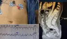Taquicardia, dolor abdominal y torácico como presentación del síndrome de la persona rígida en diabético