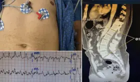 Taquicardia, dolor abdominal y torácico como presentación del síndrome de la persona rígida en diabético