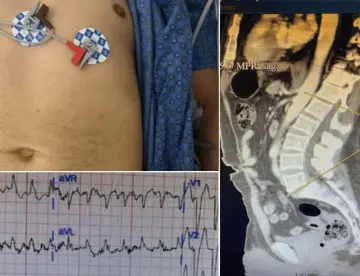 Taquicardia, dolor abdominal y torácico como presentación del síndrome de la persona rígida en diabético