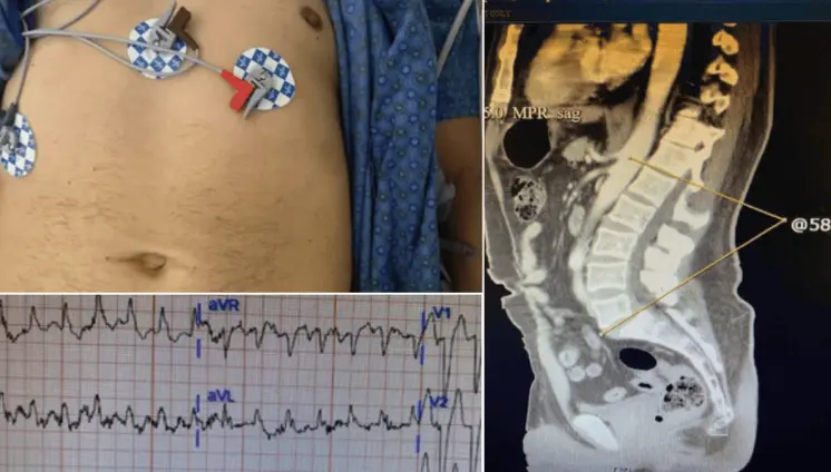 Taquicardia, dolor abdominal y torácico como presentación del síndrome de la persona rígida en diabético
