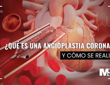 ¿Qué es una angioplastia coronaria y cómo se realiza?