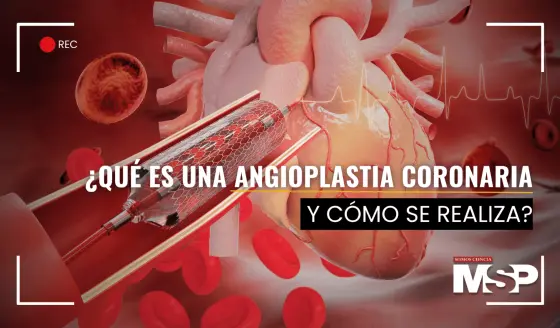 ¿Qué es una angioplastia coronaria y cómo se realiza?