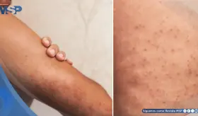 ¿Piel áspera y bultos en brazos o muslos? Descubre qué es la queratosis pilaris: causas, y tratamiento
