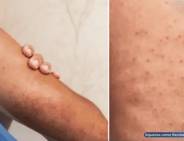 ¿Piel áspera y bultos en brazos o muslos? Descubre qué es la queratosis pilaris: causas, y tratamiento