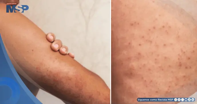 ¿Piel áspera y bultos en brazos o muslos? Descubre qué es la queratosis pilaris: causas, y tratamiento