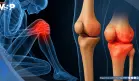 La condrocalcinosis podría aumentar 75% el riesgo de desarrollar osteoartritis de rodilla, según estudio