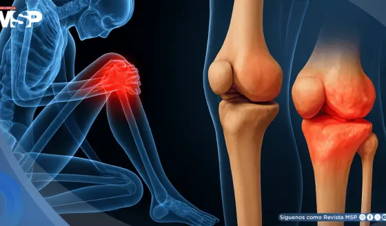 La condrocalcinosis podría aumentar 75% el riesgo de desarrollar osteoartritis de rodilla, según estudio
