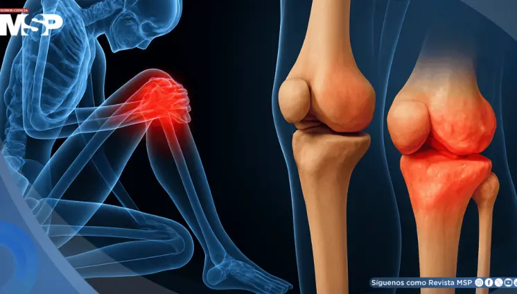 La condrocalcinosis podría aumentar 75% el riesgo de desarrollar osteoartritis de rodilla, según estudio La condrocalcinosis podría aumentar 75% el riesgo de desarrollar osteoartritis de rodilla, según estudio