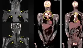 Masa cervical, fiebre y pérdida de peso como presentación de un linfoma de Hodgkin con carga viral