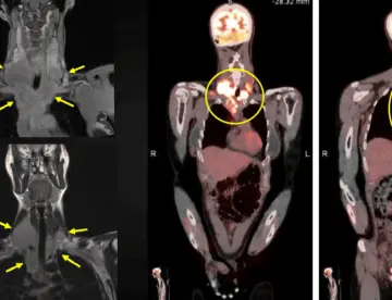 Masa cervical, fiebre y pérdida de peso como presentación de un linfoma de Hodgkin con carga viral