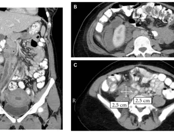 Dolor pélvico y masa abdominal palpable como presentación de trombosis venosa ovárica tras el parto