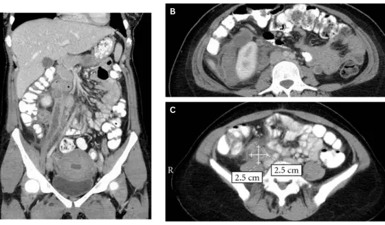 Dolor pélvico y masa abdominal palpable como presentación de trombosis venosa ovárica tras el parto
