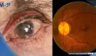 Dispositivo permite drenaje efectivo del líquido ocular y promete mejores resultados en el glaucoma